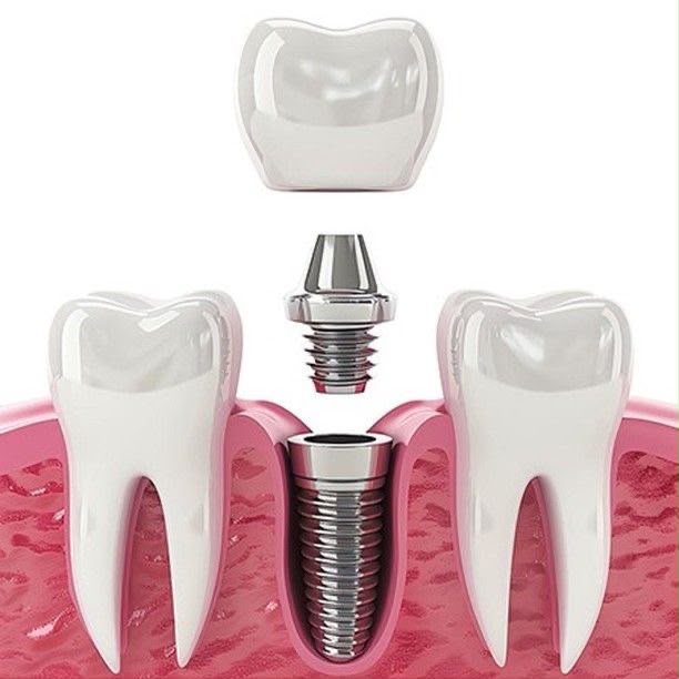 Dental Implants